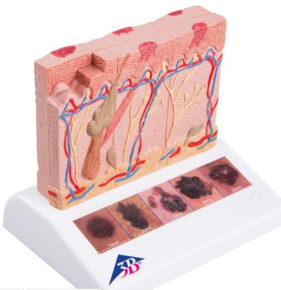 Modelo de cáncer de piel con 5 etapas, ampliado 8 veces.3B Scientific 1000293[J15]
