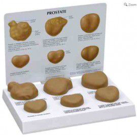 Maqueta de tipos de Próstata 3BScientific 1019544 [W33366]