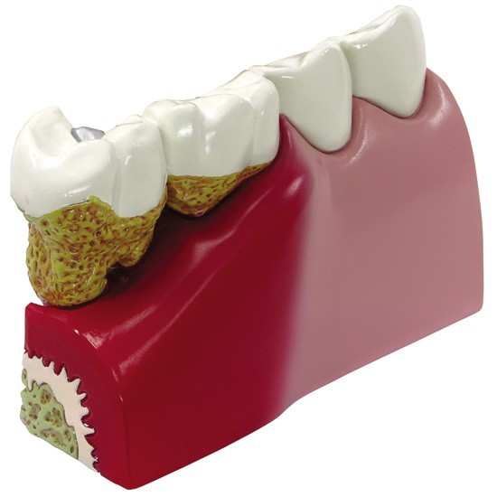 Maqueta de dientes con patologías comunes GPI 2860