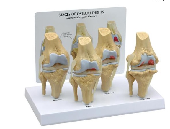 Conjunto de modelo de rodilla osteoartrítica, 4 fases / 1019502